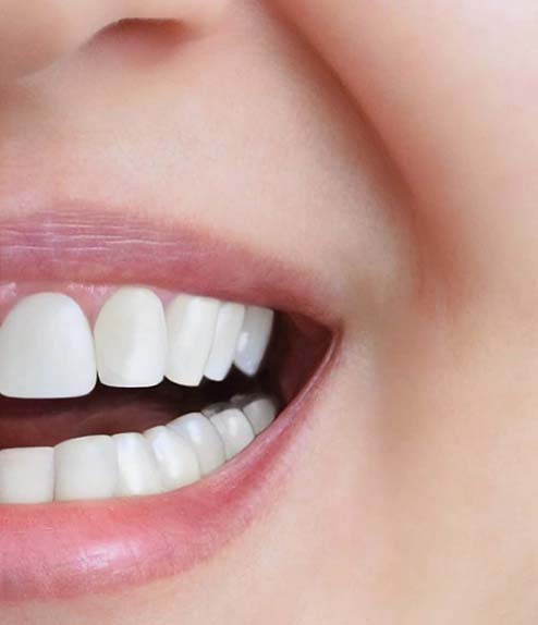 Smile Makeover after treatment