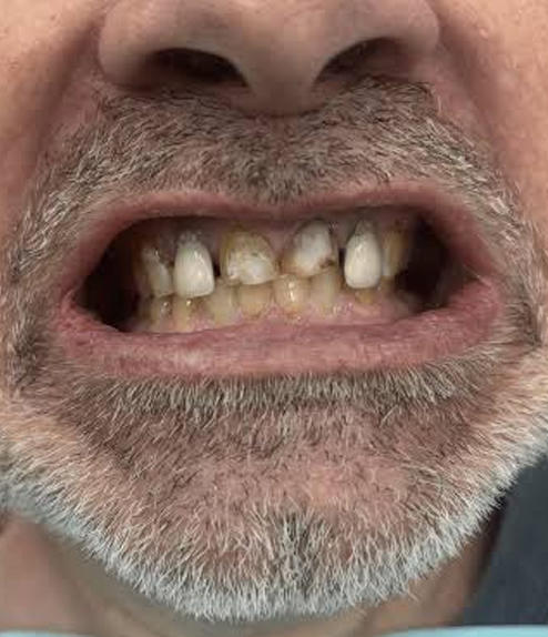 Dental Crown before treatment
