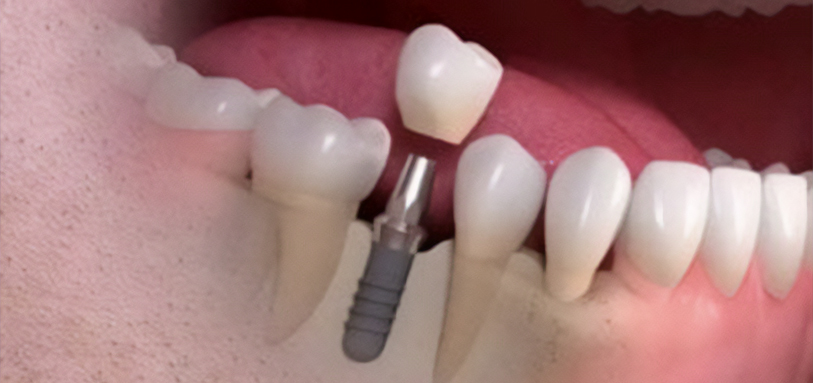 Guided Implant Placement No Guesswork