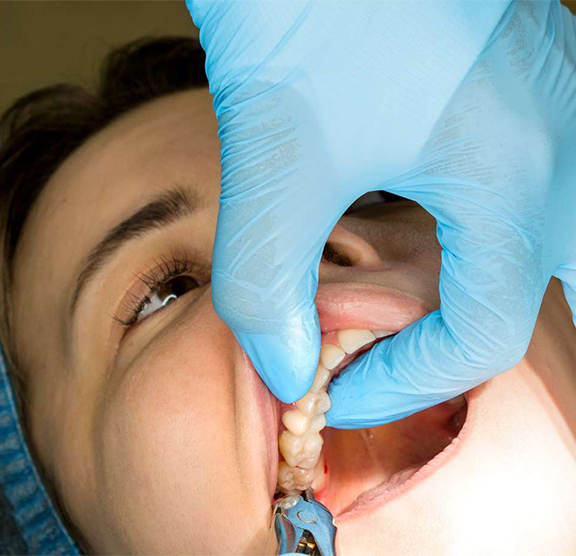 Tooth Removal