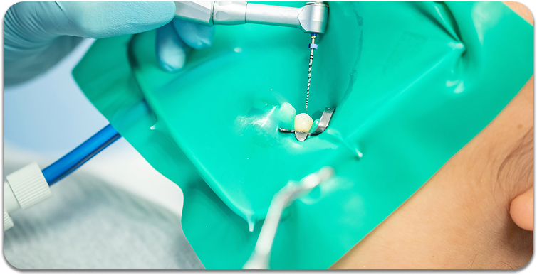 What Is a Root Canal - And Why Do People Fear It for No Reason?